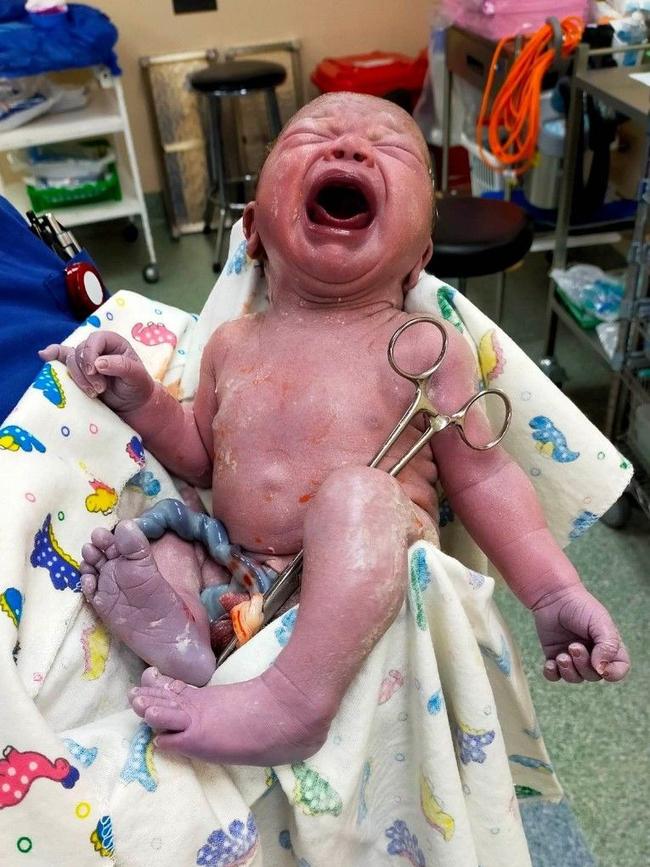 Austin after his birth. Picture: Supplied