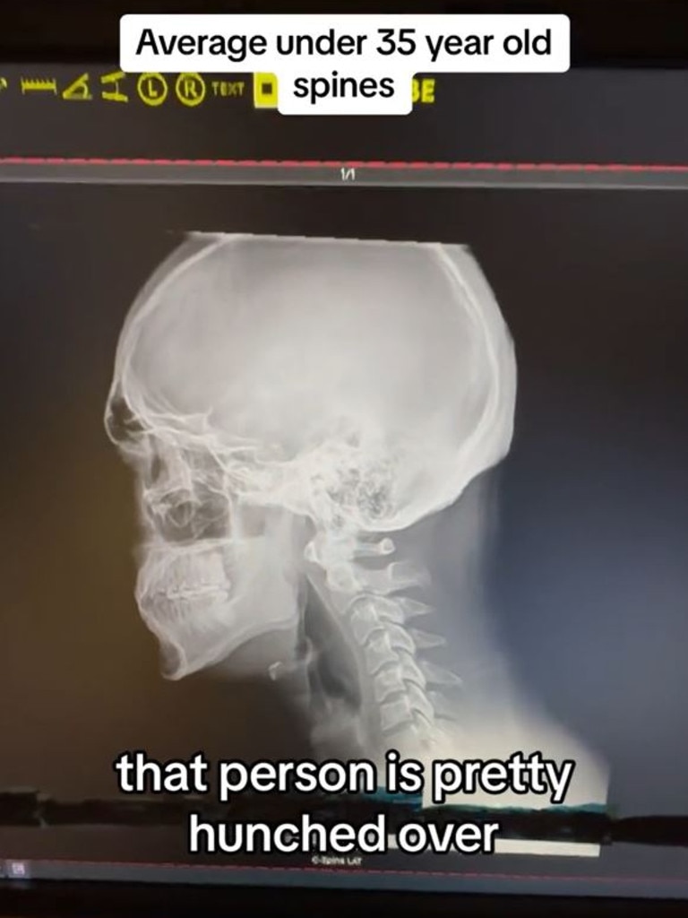 He then showed an X-ray of a 26-year-old who is already showing signs of developing a hunch. Picture: @desmoineschiro/TikTok
