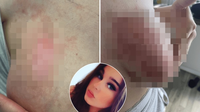 Mum’s baby bottle warning after ‘explosion peeled half her nipple off’