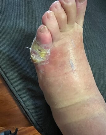 Mr Dorain had his little toe and part of his foot amputated.