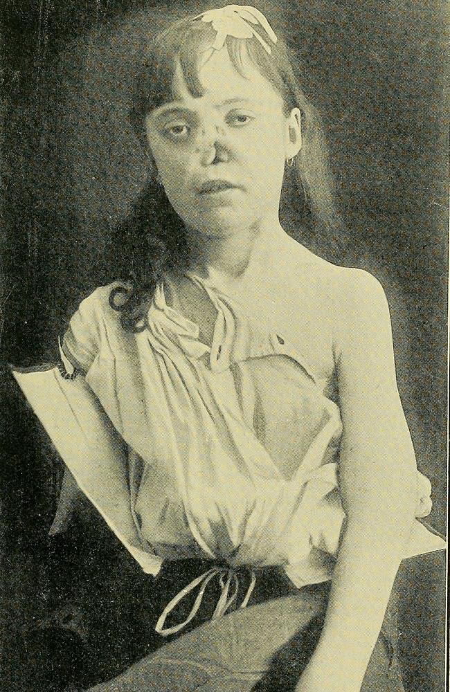 A victim of syphilis from 1895. Picture: Countway Library