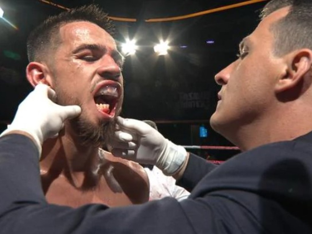 Ben Hussain broke his jaw in his fight.