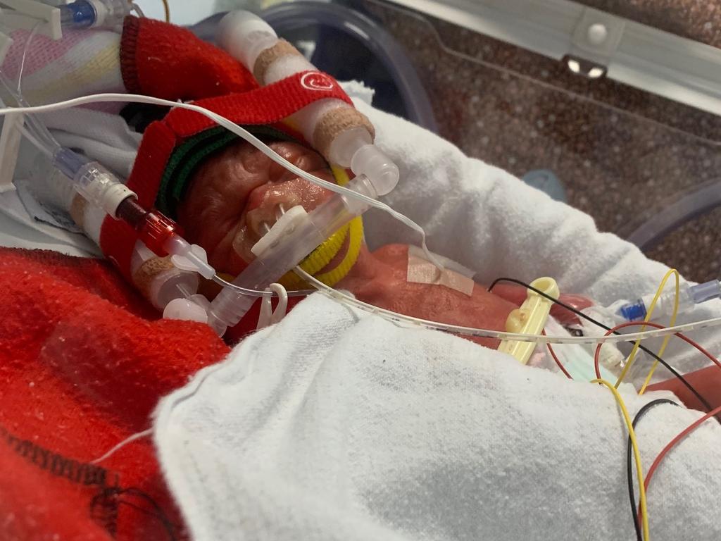 World's most premature baby defies sub-1% survival odds to break