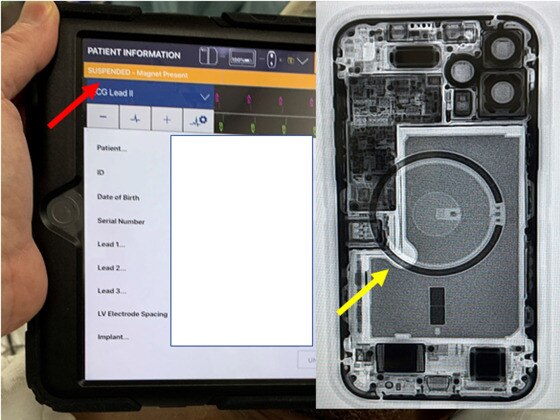 A device programmer shows the suspension of ICD therapies (orange bar, red arrow) with iPhone 12 laying over a patient’s chest (green arrow) and the fluoroscopy of iPhone 12 showing the circular magnet array (yellow arrow). Picture: Heart Rhythm Society