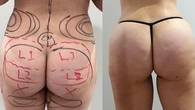 Before and after shots of a doctor, 35, who had a Brazilian butt lift procedure in November by Dr Kourosh Tavakoli.