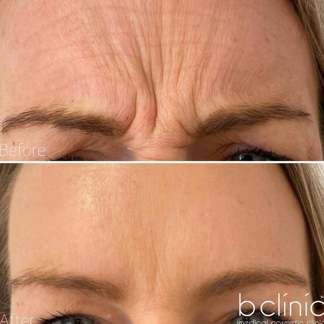 Anti-wrinkle injections can create a more refreshed appearance. Picture: b clinic