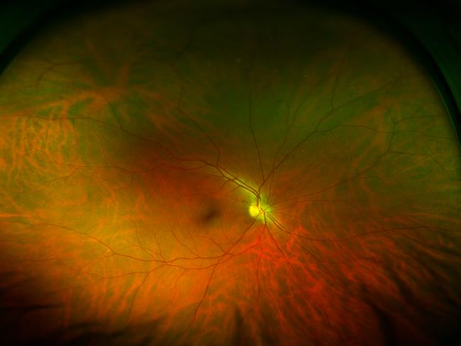 This is what a normal, healthy retina looks like.