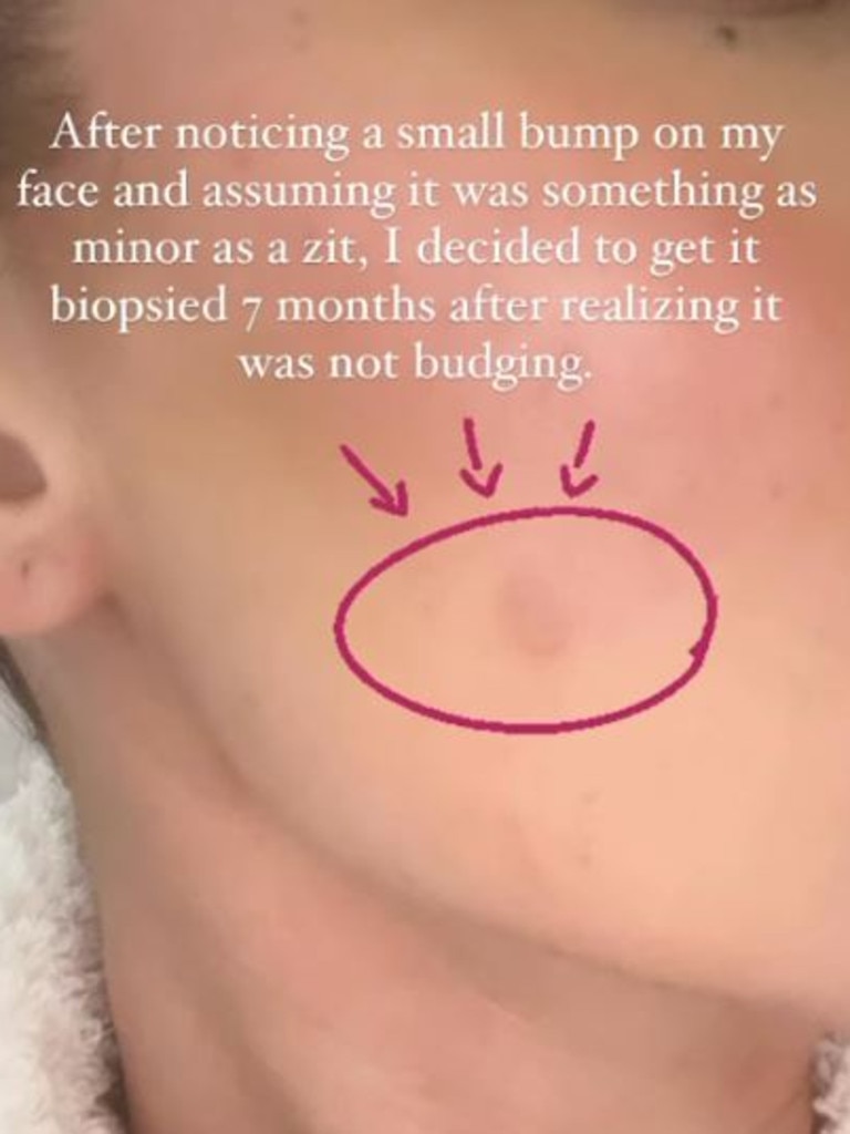 The 38-year-old said she initially assumed the bump was ‘something as minor as a zit’. Picture: Instagram