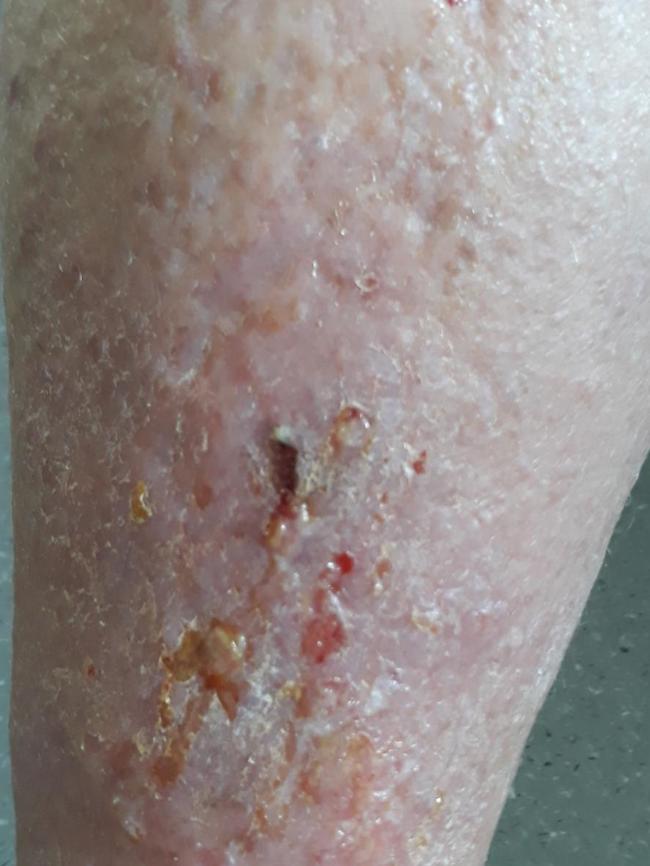 A man found with maggots in his leg/foot while in care at the Roy Fagan Centre. Picture: SUPPLIED