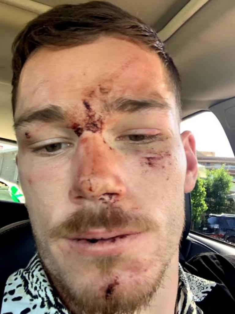 The Canberra Raiders hooker posted images of his injuries after the fight.