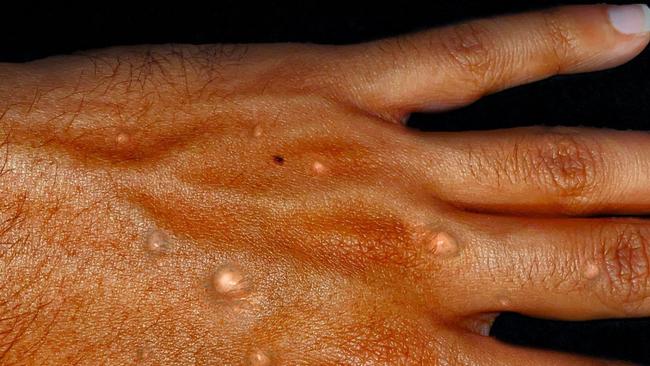 Mpox on a hand. Picture: Supplied
