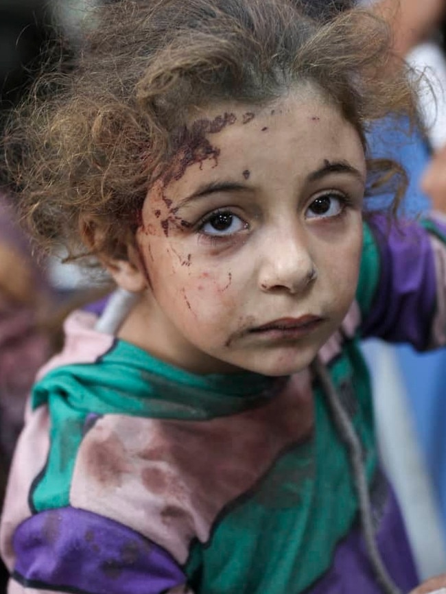 A young girl at Gaza City hospital on Monday. Picture: Omar Al-Qattaa/AFP/ Getty Images