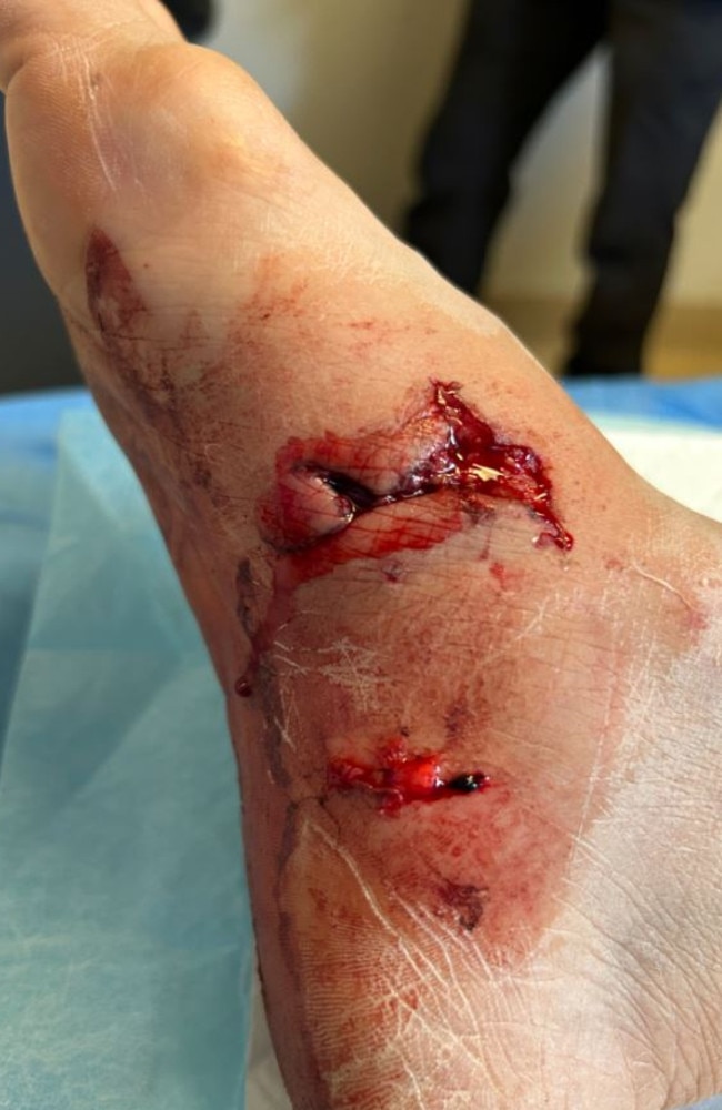 A postie in Kalgoorlie sustained a serious injury during an attack. Picture: Supplied.
