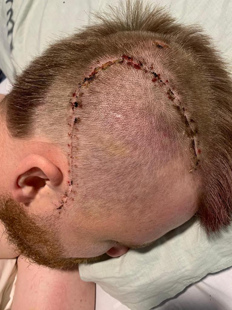 Harry Froling’s severe head wound following surgery to treat a fracture skull and bleeding on the brain. Picture: Twitter / Shane Froling