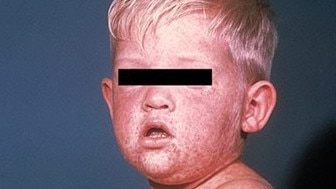 About three in every 1000 measles cases end in death.