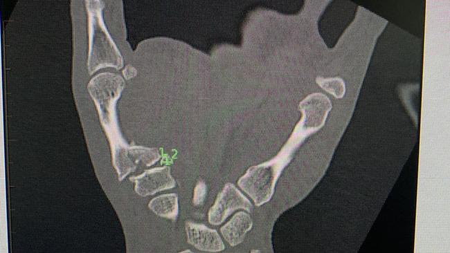 The X-Ray showing Volkanovski’s broken hand.