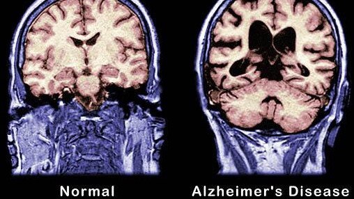 Brain scans showing normal brain and brain with Alzheimer's disease. Note enlarged ventricles and shrinkage of brain away from skull in the diseased brain.