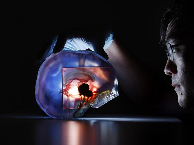 Keng-Yin Lai from UNSW inspects the 3D printout of Isaac’s brain that surgeons will use to map out the surgery. Picture: Sam Ruttyn