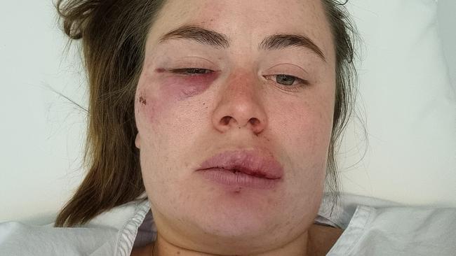 Ms Austin, who ran for the Greens in the Senate in the 2022 federal election, was hospitalised following the attack. Picture: Sissy Austin / Facebook