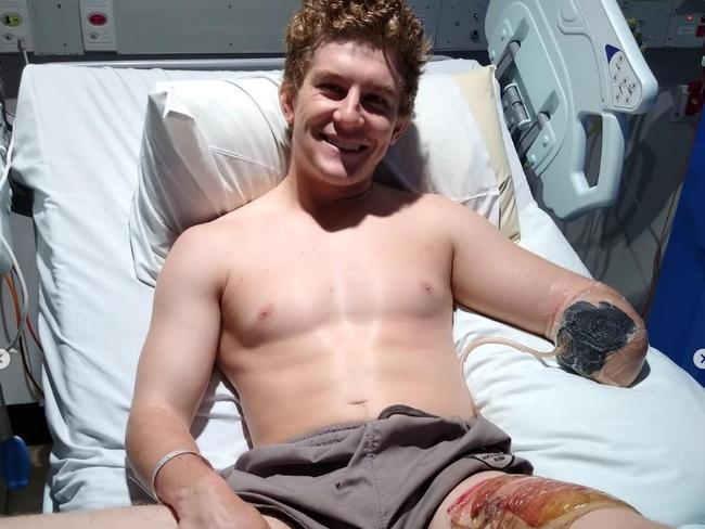 British backpacker Henry Dunn lost his lower left arm after a workplace accident on a remote Northern Territory cattle station.