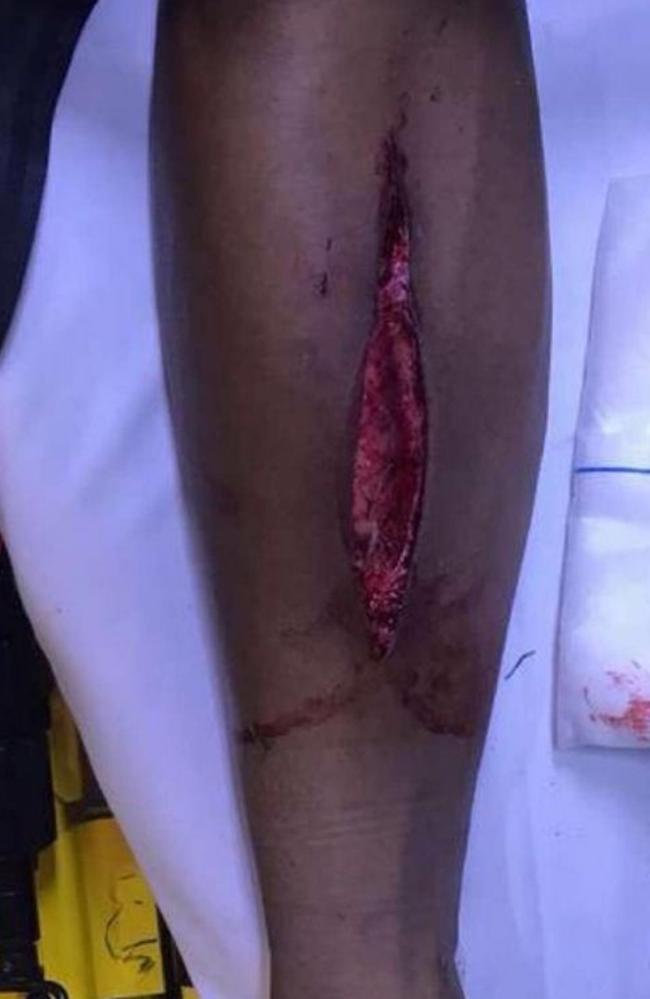 A freak accident on the footy field left Isaac Quaynor with a massive gash on his leg.