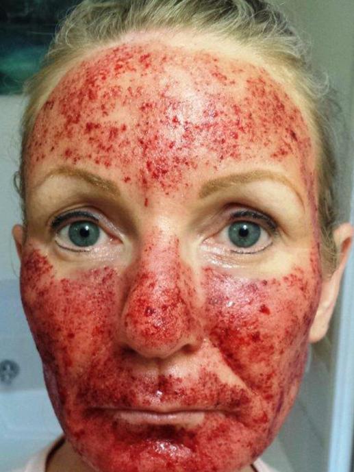 Niki Richardson’s face was burnt during laser treatment. There’s little or no regulation of non-surgical cosmetic procedures like these.