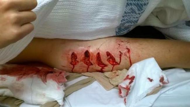 Cooper’s horrific leg wound. Picture: Amanda Abate/Channel 7/Twitter