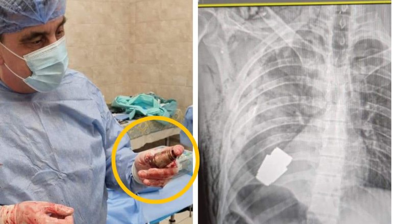 Surgeon removes live grenade from Ukrainian’s chest