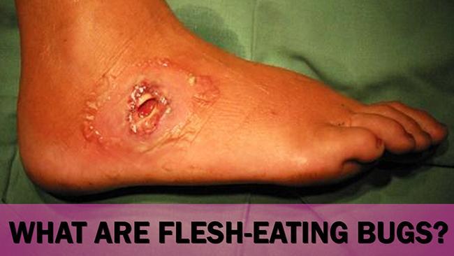 GRAPHIC: What are flesh-eating bugs?