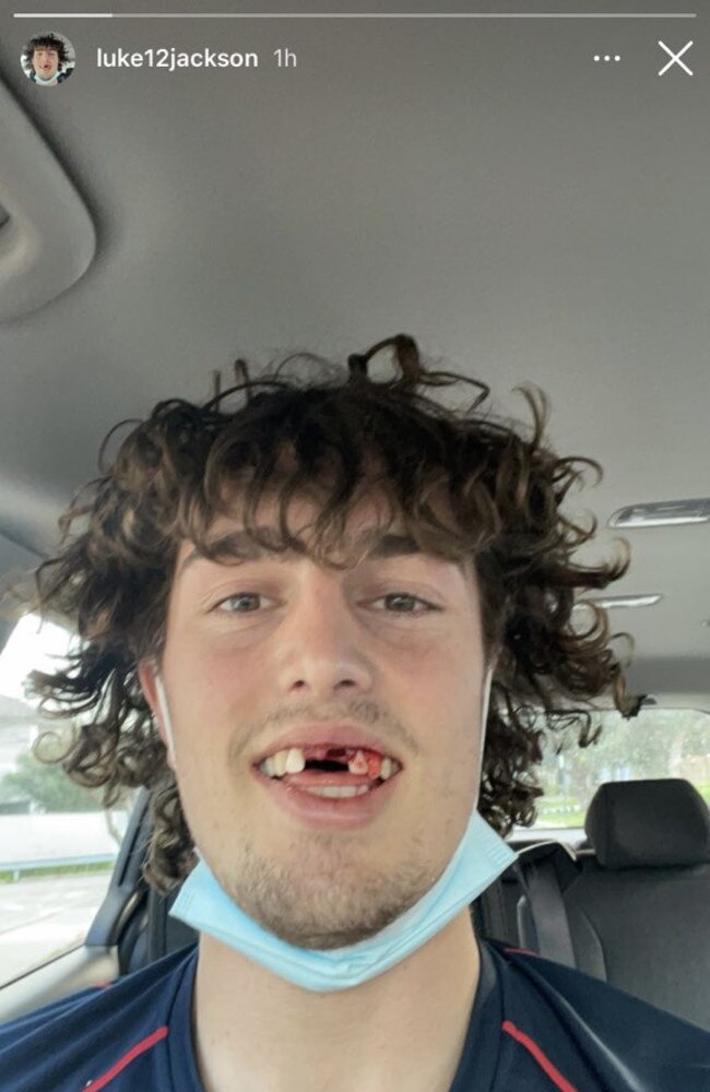 Demon Luke Jackson has apologised to his mum for the shocking state of his teeth after the Demon copped a blow in the clash with Brisbane. Picture: Instagram