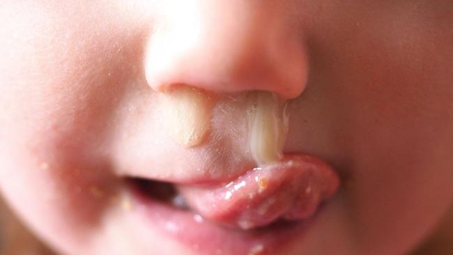 No green snot doesn't mean you have a bacterial infection and need antibiotics. Image: iStock