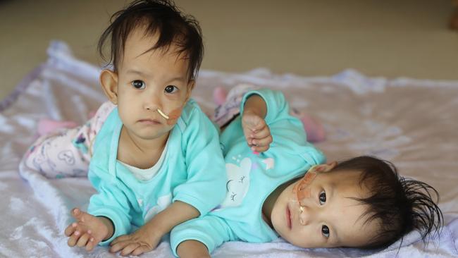 Conjoined Bhutanese twins Nima and Dawa. Picture: Alex Coppel