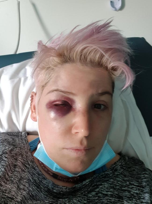 Jed Vanter allegedly shattered Casey Freeman’s eye socket in the attack.