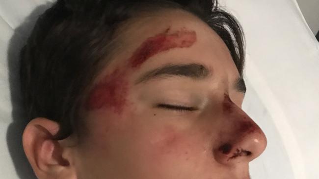 Frankie Parrino, 13, spent almost a week in hospital with a fractured skill after the accident. Picture: Supplied