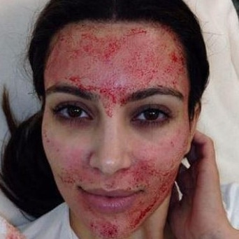 Kim Kardashian made vampire facials famous after posting this picture on Twitter. Doctors remind patients cosmetic injectables require a medical consultation by a doctor.