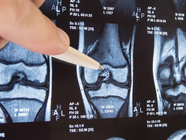 Knee joint x-ray or MRI. Doctor pointed on area of knee joint, where pathology or problem is detected, such fracture, destruction of joint, osteoarthritis. Diagnosis of knee diseases by radiology