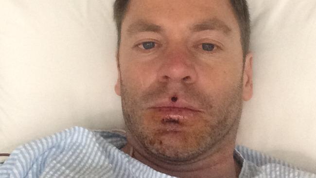 Stephen Smith needed emergency care to save him from four bee stings.