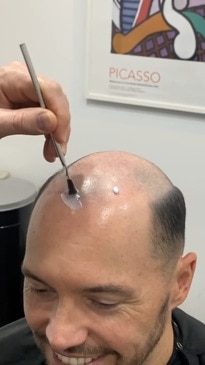 Balding reporter tries out a "hair system"