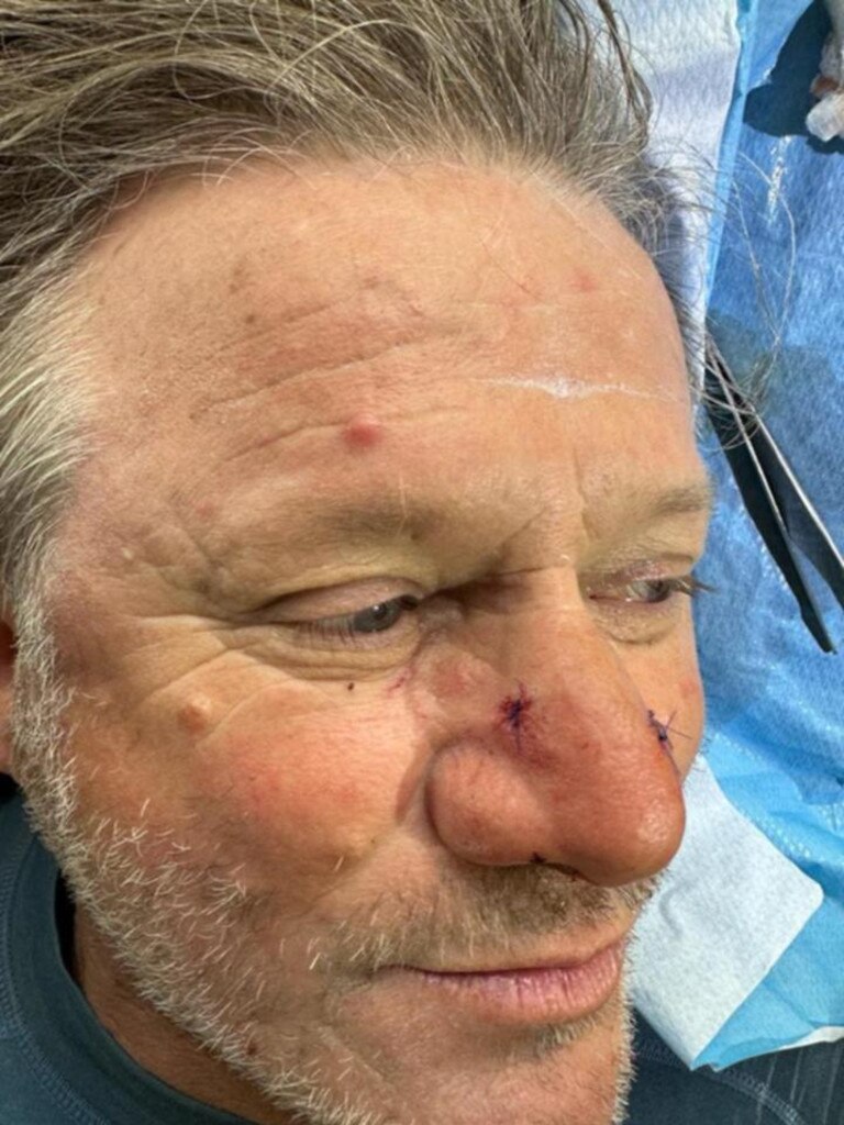 Mr Kezic post-impromptu surgery with three fresh stitches in his nose. Picture: Supplied