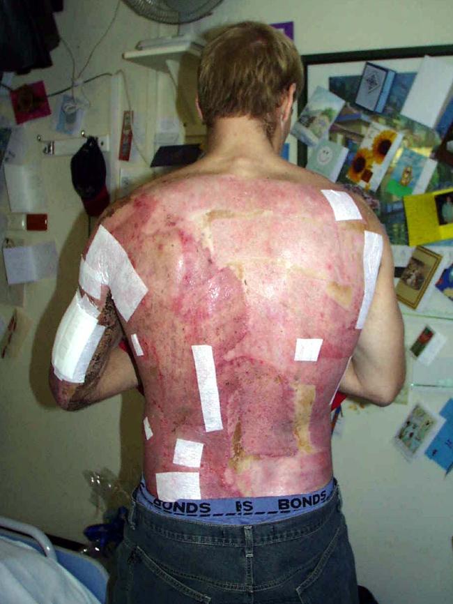 Julian Burton after he was horribly injured and burned in the 2002 Bali bombings.