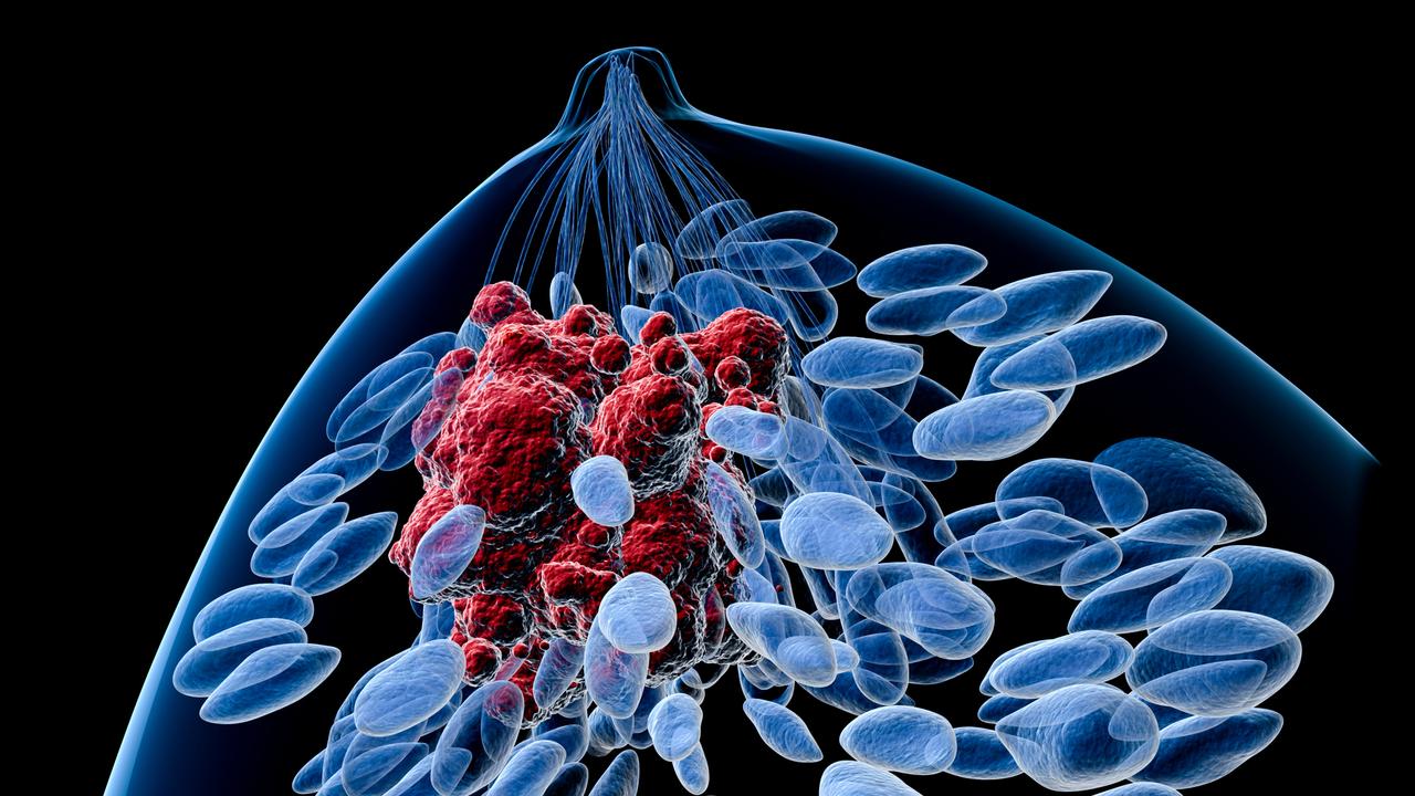 Top view of a female breast with a tumor. Features body silhouette, lobules, lactiferous ducts and tumor. Picture: iStock.