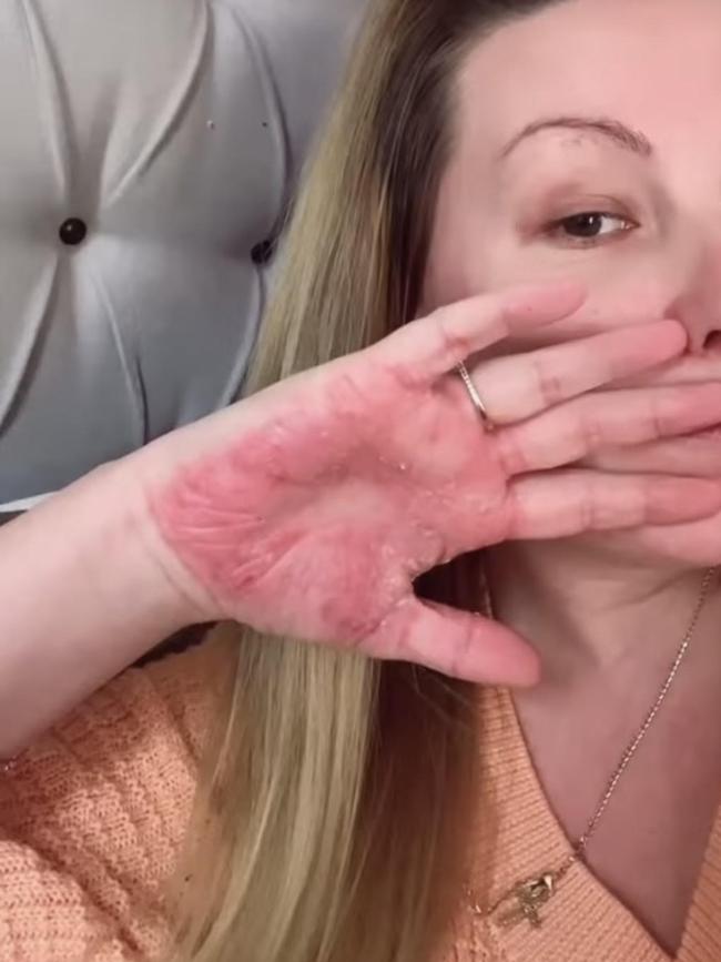 Nicole Preece shares her experience with psoriasis on her Instagram, spreading awareness and normalising the condition. Picture: @aussiemum_to.6 / Instagram