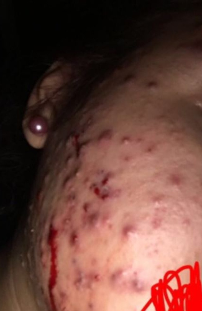 She began to suffer from severe cystic acne. Picture: Twitter