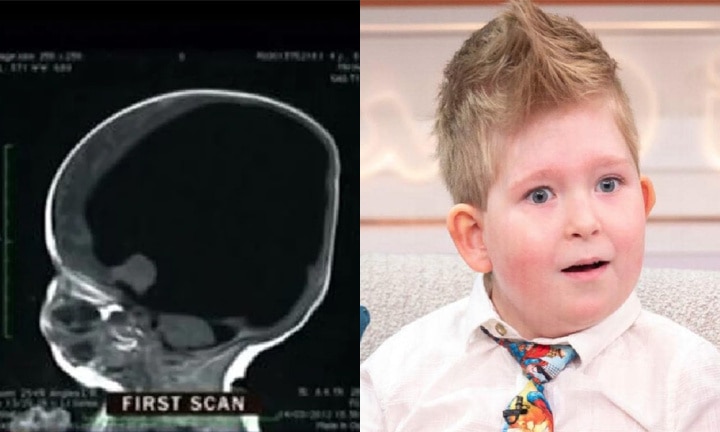 baby born without brain