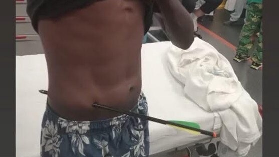 A Daly River local who presented to one of the clinics with an arrow still in his side. Picture: Supplied