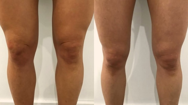 Exercises for saggy discount knees