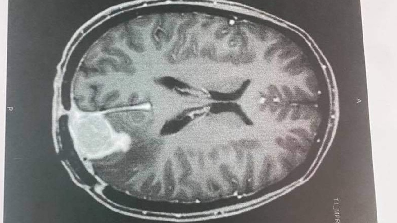 Brooke Balgowan had a rare brain tumour, Anaplastic Ependymoma.