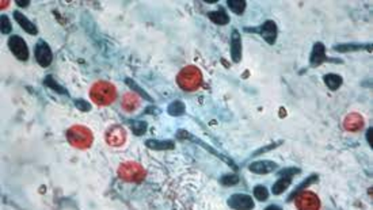 Cryptosporidiosis is a gastrointestinal disease caused by the microscopic parasite Cryptosporidium and is a common cause of acute diarrhoea in young children. Photo: TN Department of Health