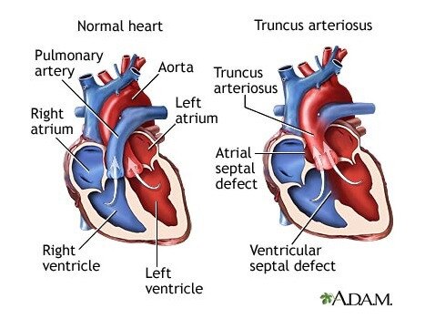 Present at birth, Truncus arteriosus is a rare type of heart disease in which a single blood vessel (truncus arteriosus) comes out of the right and left ventricles, instead of the normal 2 vessels (pulmonary artery and aorta). Picture: A.D.A.M.