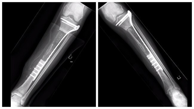 X-rays of Asha Morris's left tibia – on the left, soon after surgery to remove 12.5cm of bone and replace it with a 3D printed implant, and on the right in October, about seven months after the operation. The X-ray on the right shows bone growth. Picture Supplied.